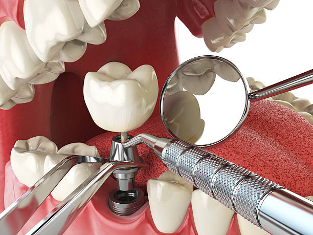 Best Knocked-Out Tooth (Avulsed Tooth) Treatment in East Palo Alto, CA